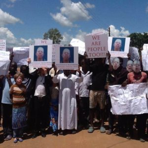 albinism in Malawi