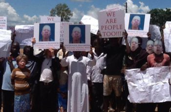 albinism in Malawi