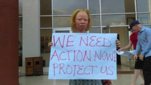 albinism in Malawi